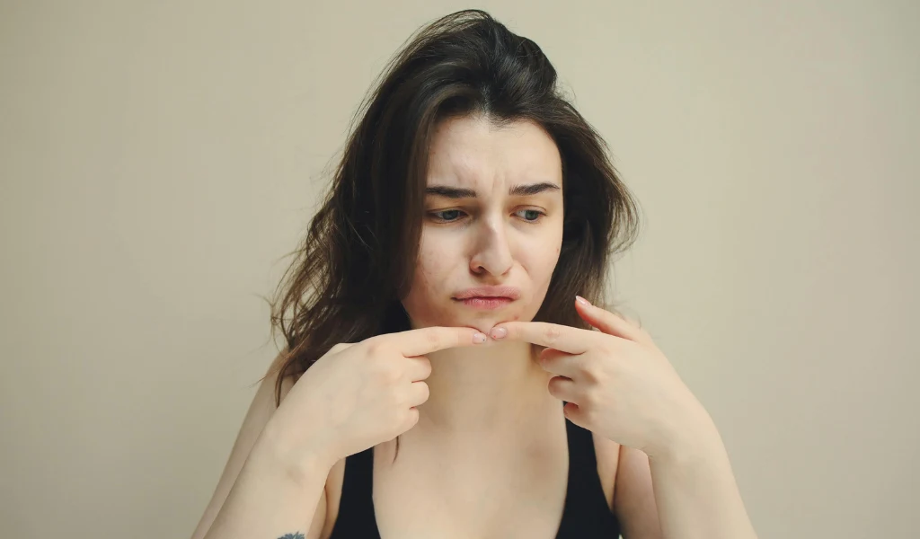 Acheter Isotrétinoïne 20 mg : Une solution efficace contre l’acné sévère