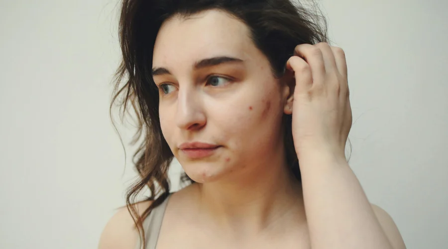 Acheter Isotrétinoïne 20 mg en ligne sans ordonnance